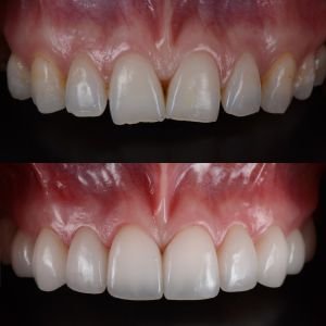 Composite Veneers