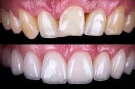 Porcelain Veneers
