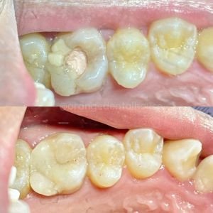 Tambal Gigi Belakang